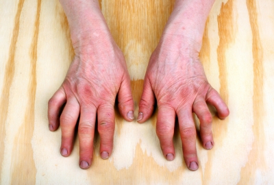 Arthritic Problems