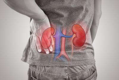 Kidney Stone