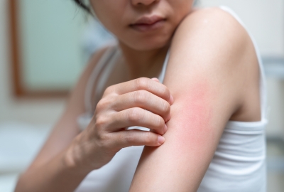 Skin Problems